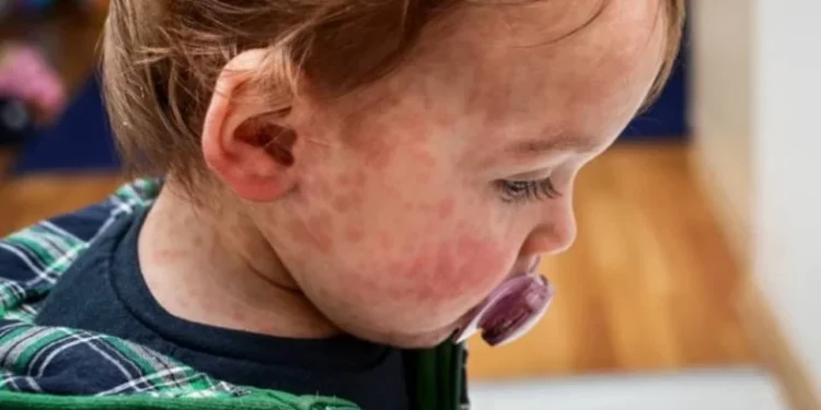 Uzmanlar Uyardı: Bebeklerde Gıda Alerjisi İçin Erken Tanışma Önerisi Geldi